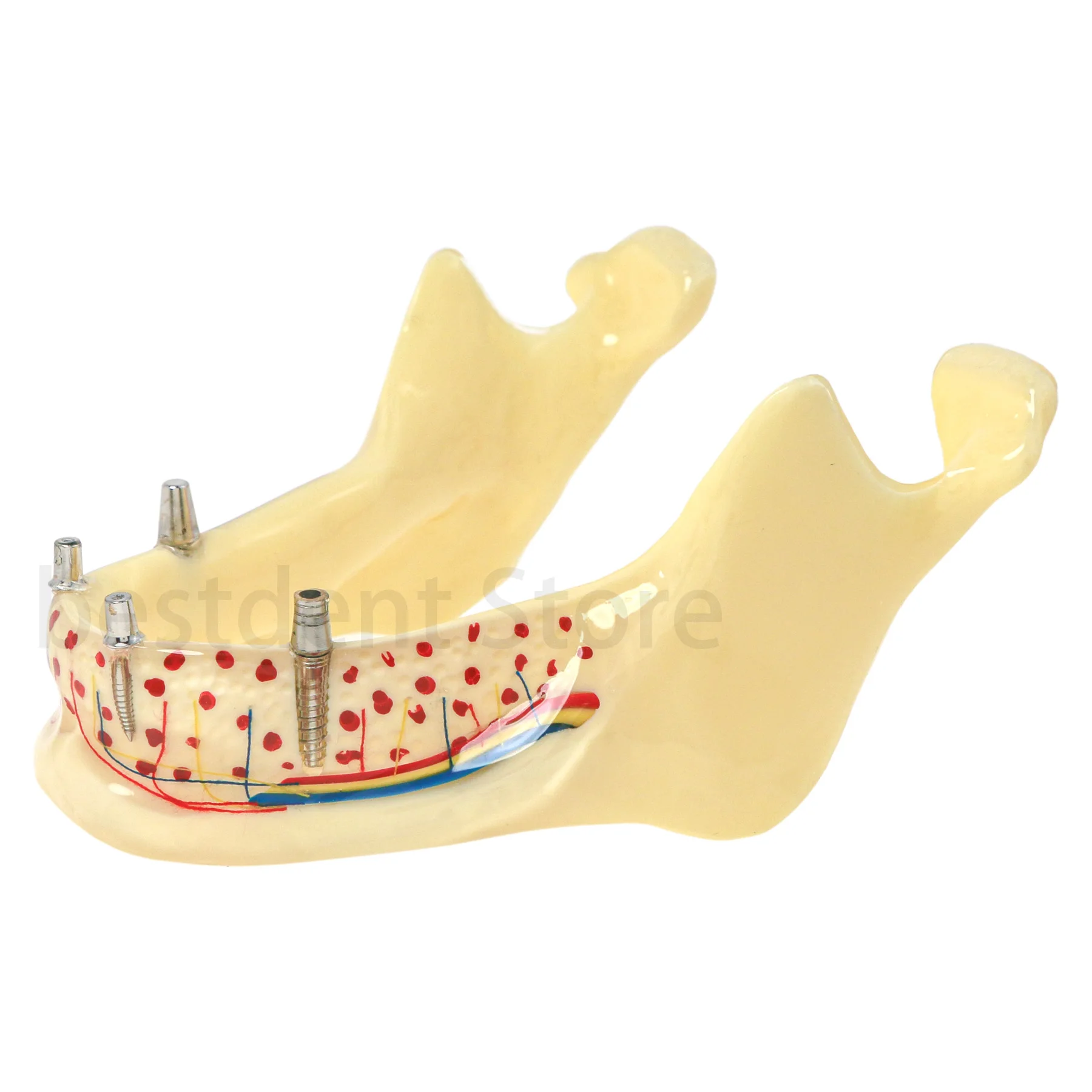 Denti per impianto dentale modello ganascia inferiore modello rimovibile 4 impianti posizione demo e direzione