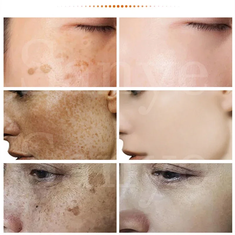 Melasma Remover Cream usuwanie ciemnego pigmentu rozjaśniający krem do twarzy znikną melaninę krem nikotynamid rozjaśniający emulsja nawilżająca