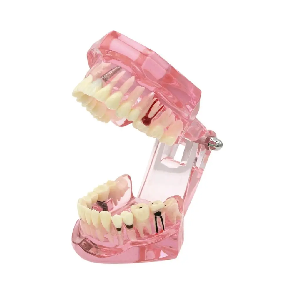 Dental Implant Teeth Model Restoration Pathology Removable Teeth Study Demo Model M2001 Pink