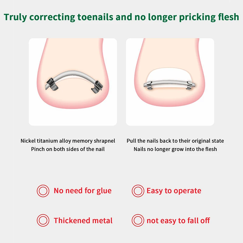 Zehen Eingewachsene Pediküre Nagel Schnalle Zehennägel Korrektor Fuß Nagel Korrektur Werkzeug Richt Clip Gebogene Klammer Korrektor