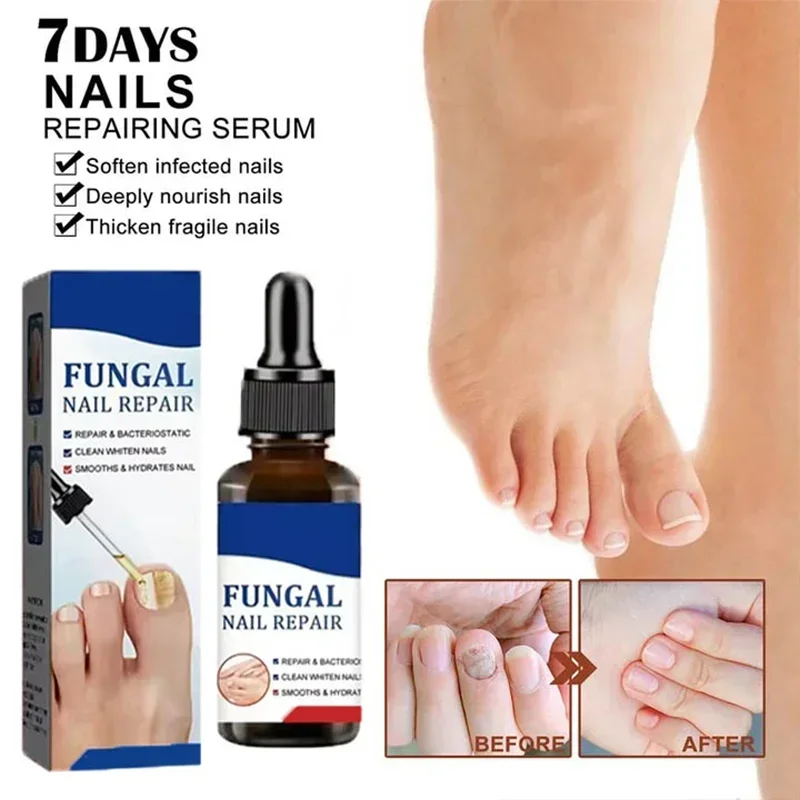 مرحبا الفطرية علاج الأظافر جوهر النفط فطريات الأظافر جهاز الليزر إصلاح أظافر أظافر علاج فطار الأظافر مع الفطر