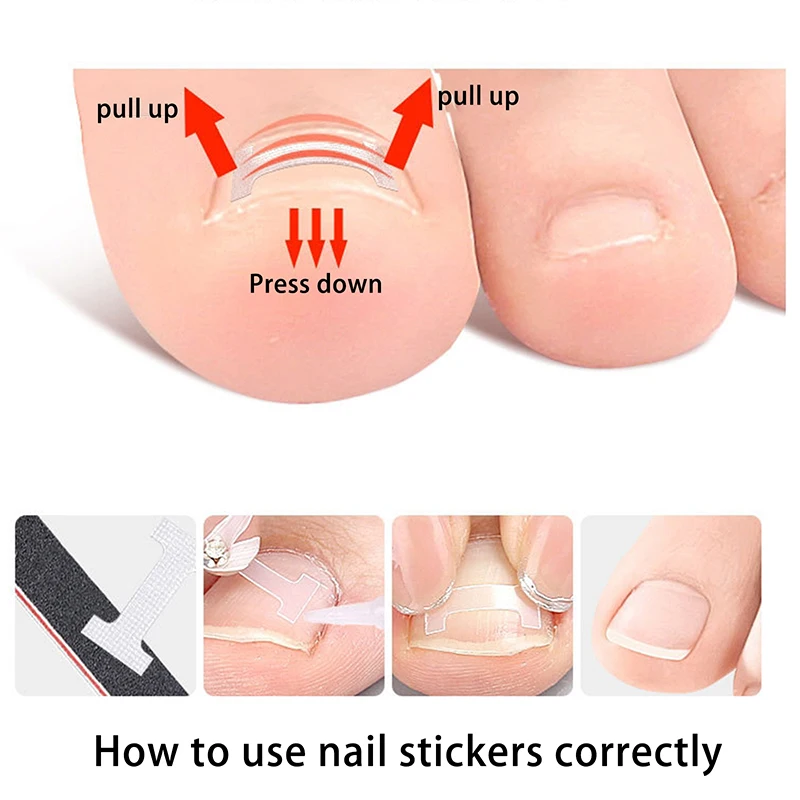 10 Pcs I-beam Orthodontic Strips Endogenous Toenail Correction Strips Nail Treatment Elastic Corrective Clip  Foot Care Tools