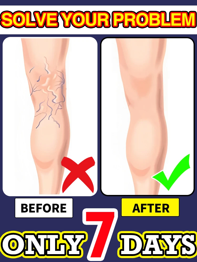 

Reverse leg health in 7 days and say goodbye to varicose vein recurrence