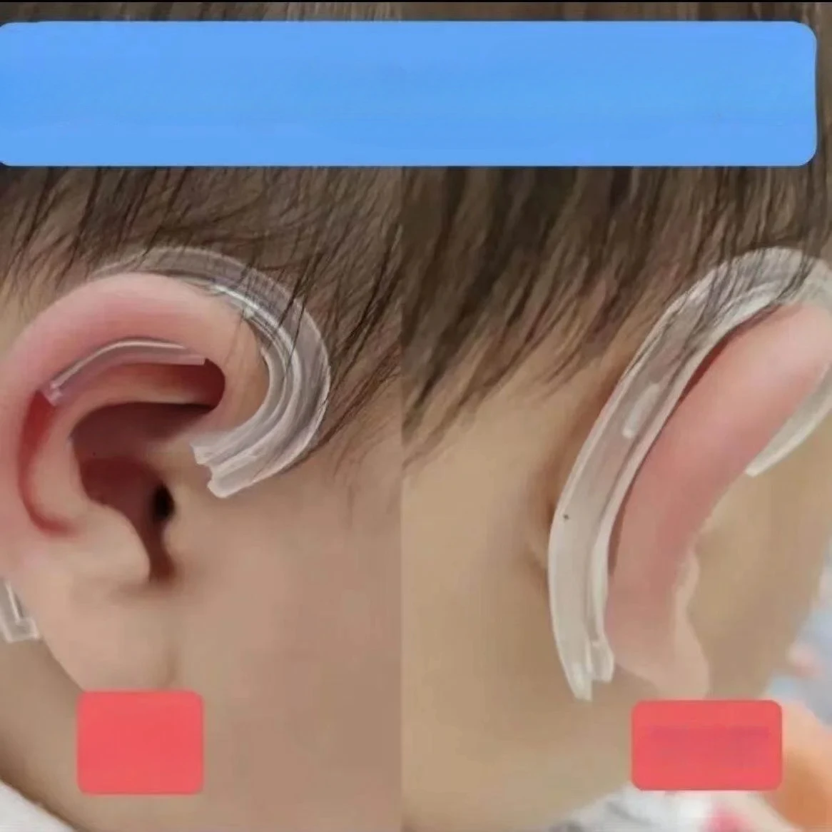 

Newborn Ear Brace Baby Ear Stickers