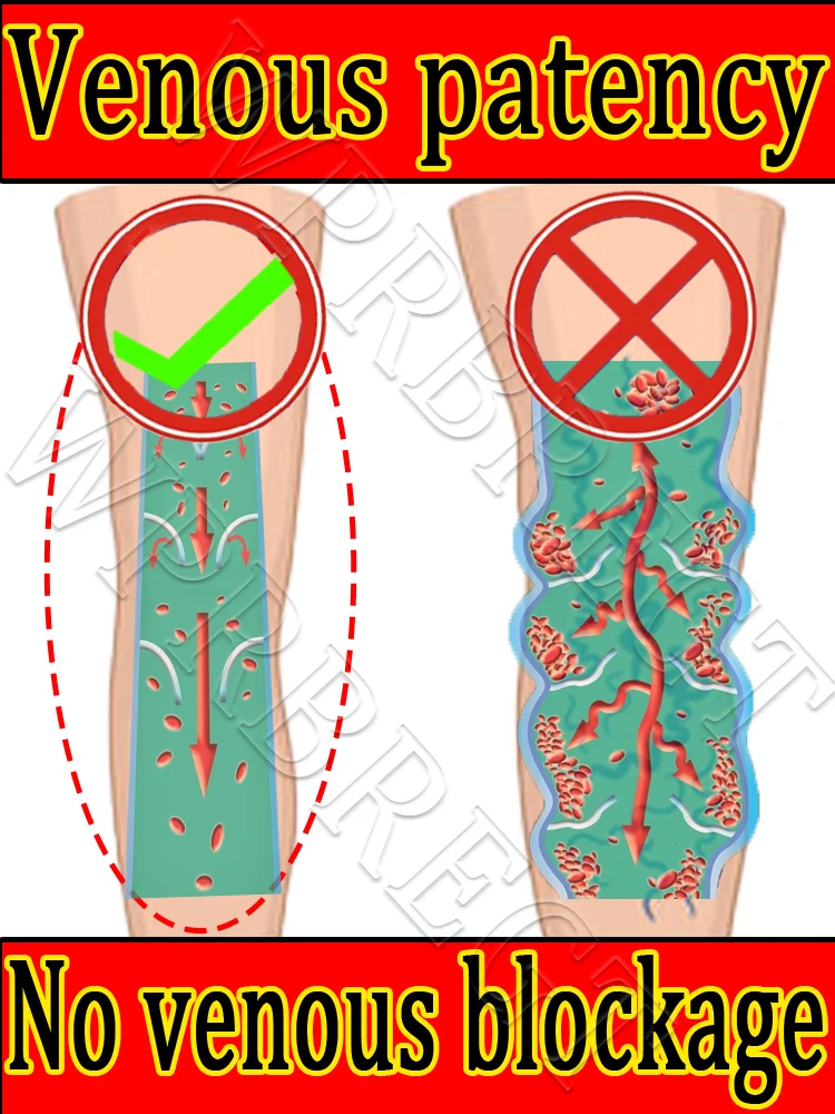 

Second generation laser pointer: treatment of varicose veins