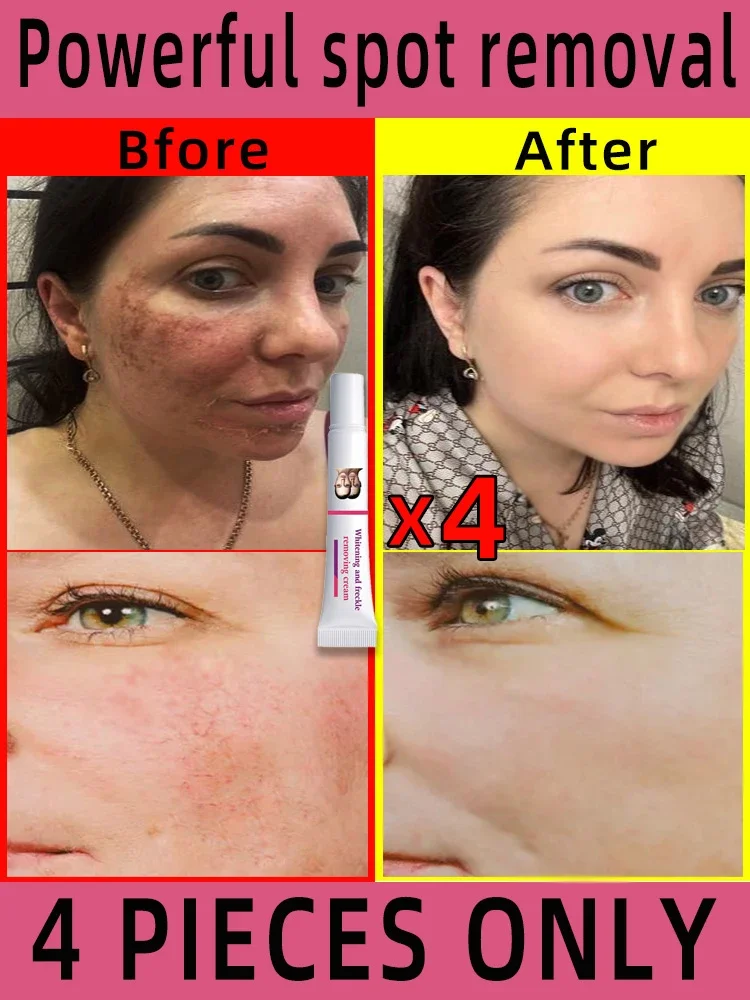 Freckles Removal Cream Remove Facial Spots Skin Dark Spot Remove Melasma Age Spots Sunspots Whitening And Freckle Removing Cream