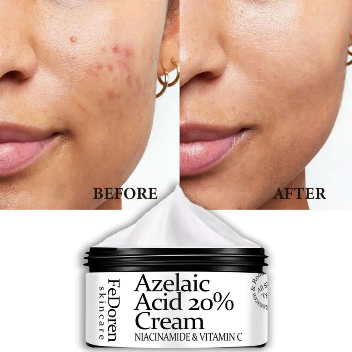 Fades Acne Cream Freckle Dark Pigment Spots Melanin Alpha Arbutin Face Cream Skin Care