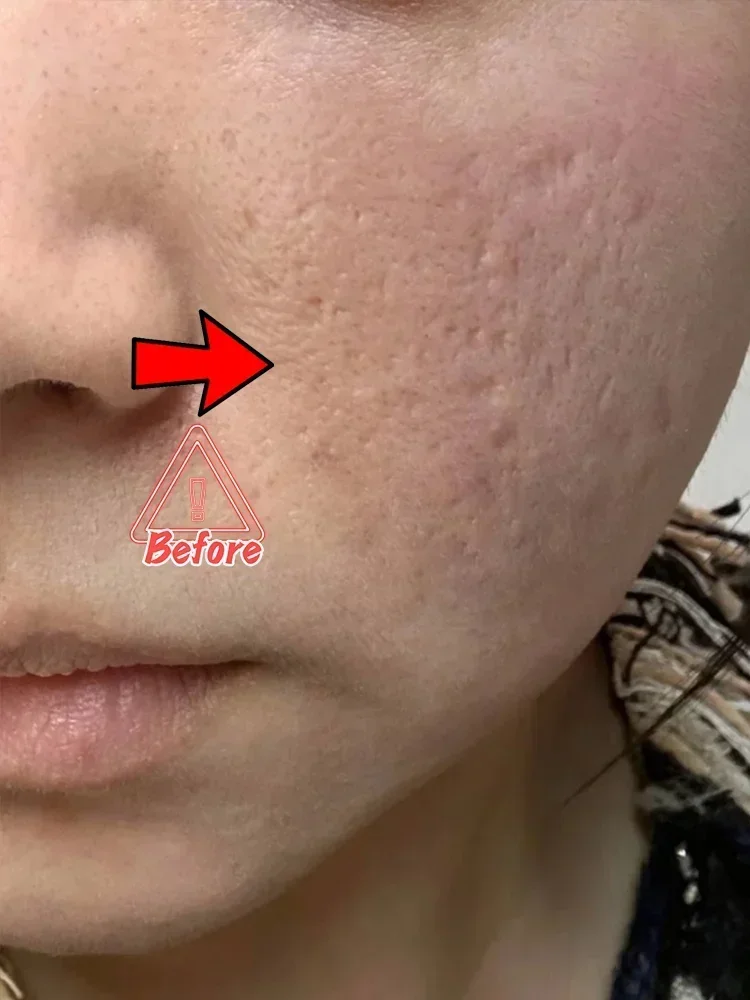 Impronte per la rimozione dell'acne Acne-pits Acne-cicatrici pasta foro riempimento rigenerazione restringere i pori dissolvenza per eliminare la riparazione dei pozzi dell'acne