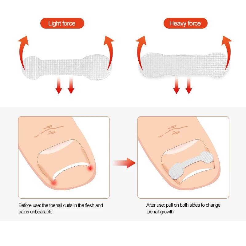 1/3/5BOXES Kit Painless Safe Practical Revolutionary Innovative Game-changer Ingrown Toenail At Home