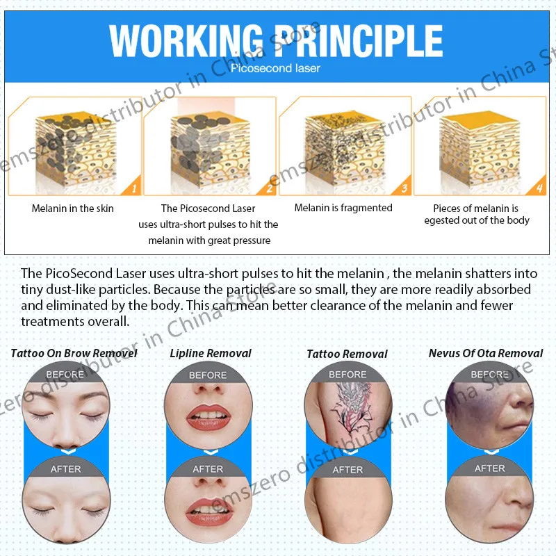 Máquina de eliminación de tatuajes de 4 cabezales recientemente actualizada, eliminación permanente de tatuajes, pigmentación de manchas, muñecas de cara negra