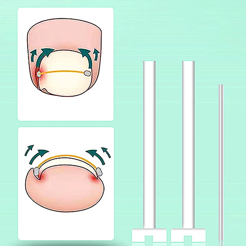 내성발톱 교정 도구, 페디큐어 복구, 임베디드 발톱 치료, 전문 내성발톱 스트레이트닝 클립 버팀대