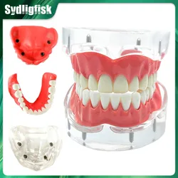 1/2Pcs Dental Implant Model Maxillary Mandibular Removable 4 Implant Overdenture Restoration Teeth Model Oral Teaching Research