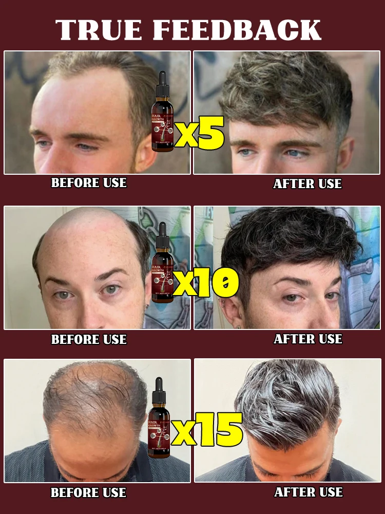 99% des acheteurs dites c'est bon, il peut restaurer les cheveux épais et la croissance des cheveux n'est plus un rêve