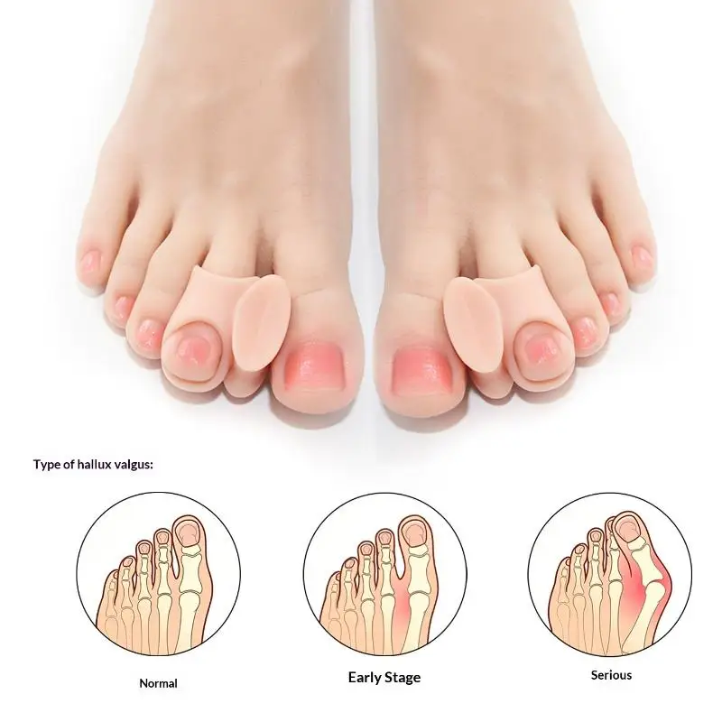 Komfortorientierte Silikon-Gel-Hallux-Valgus-Korrektoren für Tägliche Aktivitäten, Ideal zur Schmerzreduktion und -linderung – Detail 3