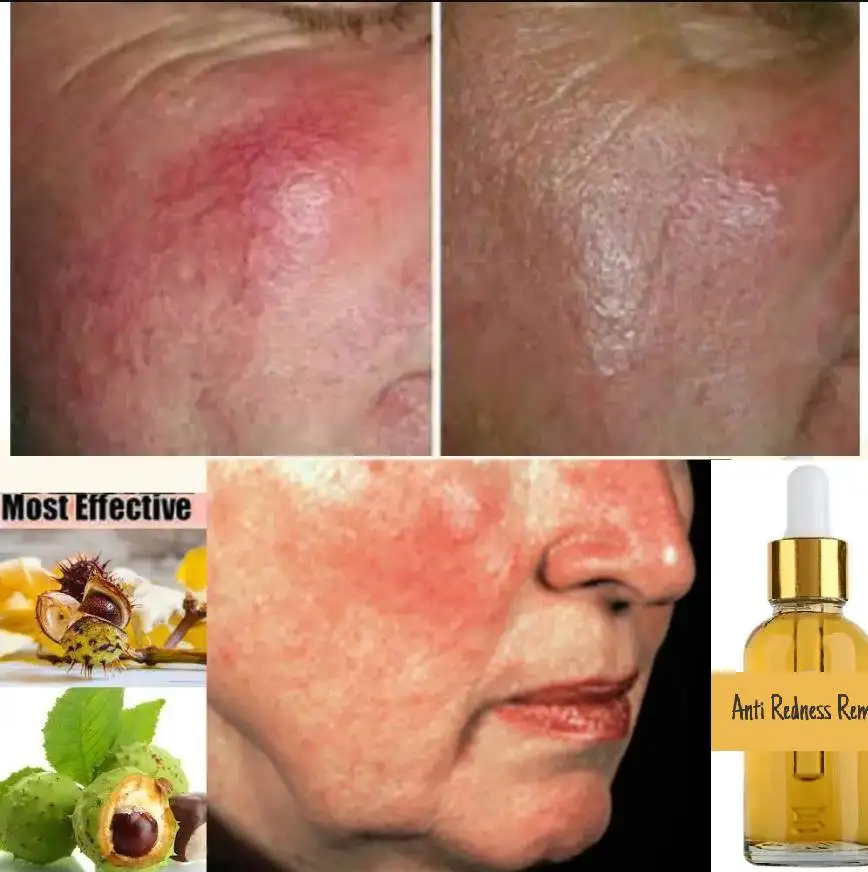 Anti Redness Remover Face Serum Oil Spider Vein Removal Advanced Calming Ingredients, Improves Irritation Clearer skin Veins