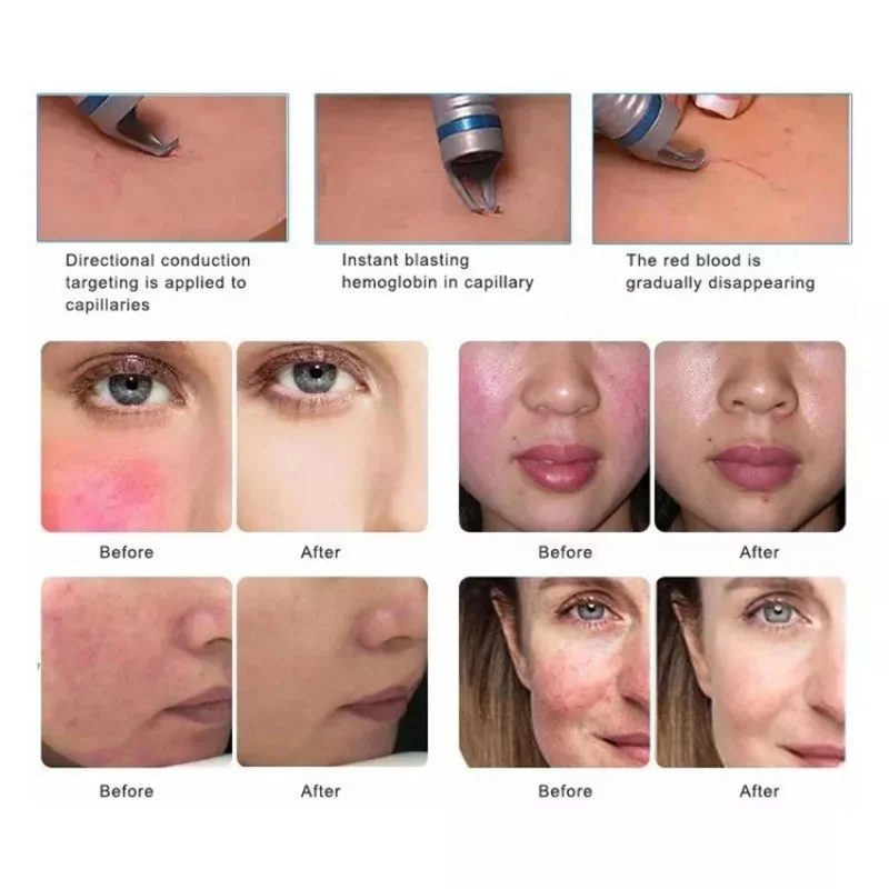 เลเซอร์ไดโอด980nm สำหรับฆ่าเชื้อเล็บและกำจัดหลอดเลือดปลอดภัยและปราศจากรอยแผลเป็นฆ่าเชื้อแมงมุมได้30วัตต์