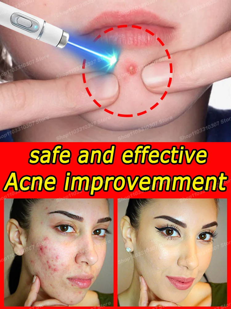 

Acne Anti Pimple Marks Serum Remedy