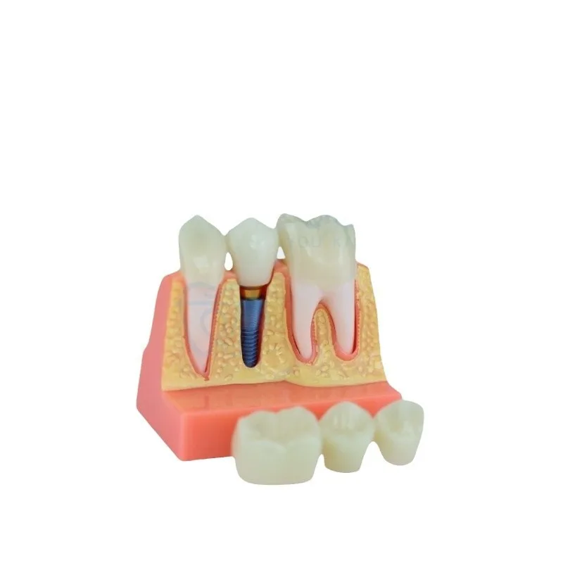 Dental Implant 4x Implant Solution Model, Denture Restoration Dental Implant Interpretation, Removable, Bridge Crown