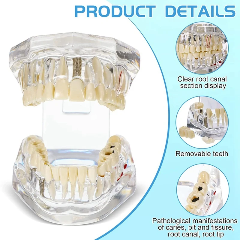 Teeth Model Disease Teeth Model  Typodonts Implant Teeth Model With Removable Teeth Dentist Standard Tooth Demonstration