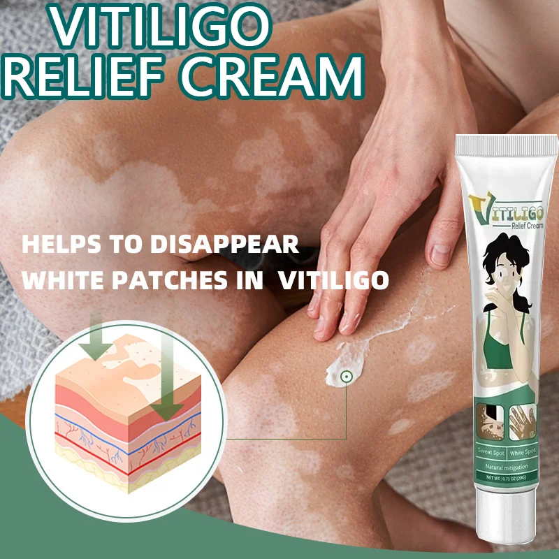 

Vitiligo relief Cream White Spot Removal Vitiligo Eliminate Vitiligo Products for Even Skin Tone Stimulates melanin synthesis