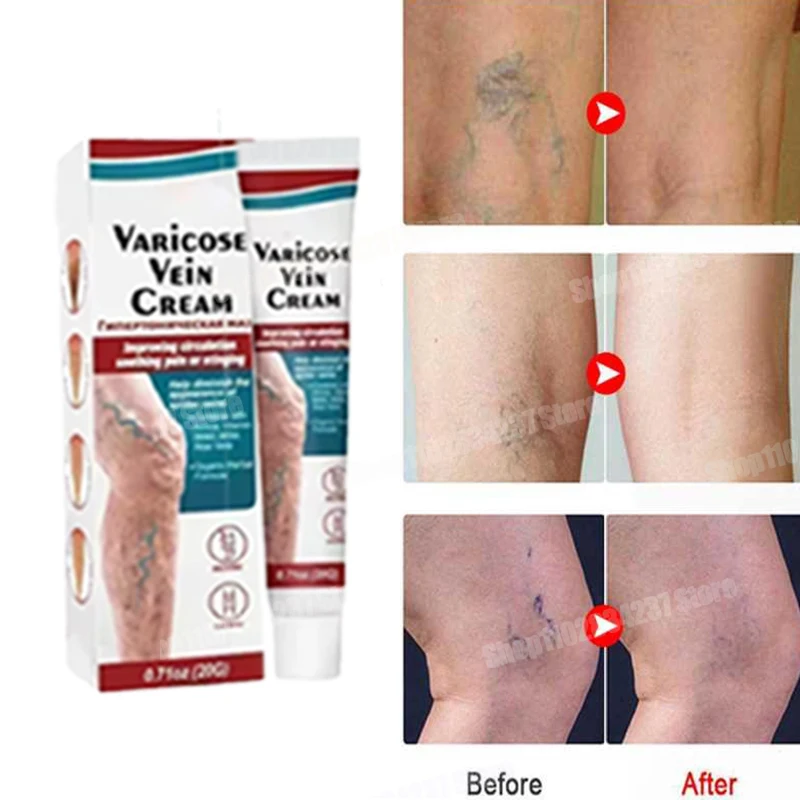 Vein repair cream reduces varicose veins, promotes blood circulation and vasoconstriction essence of leg care 2024