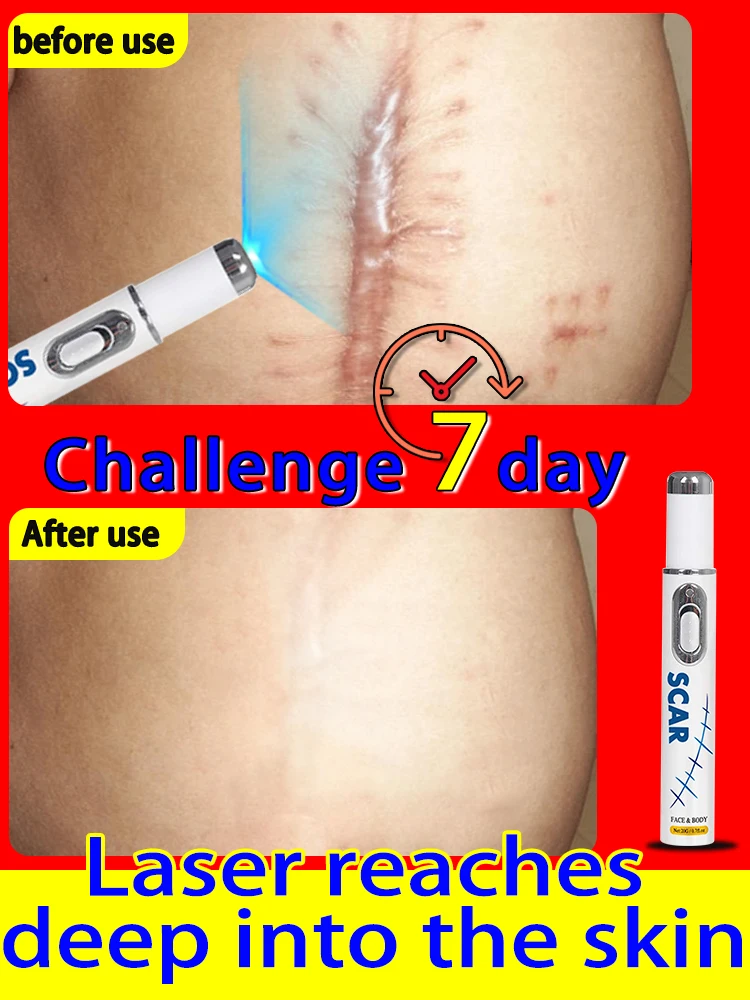 Hot Selling Laser Repair Skin Scars.