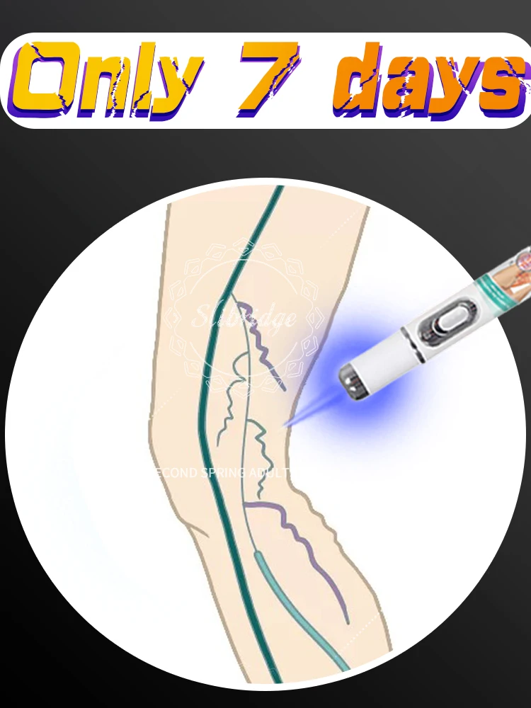 

Vein blue light tool, more discounts Reduce Uncomfortable For Legs Improving Blood Circulation Varicose Veins Pen Skin Care