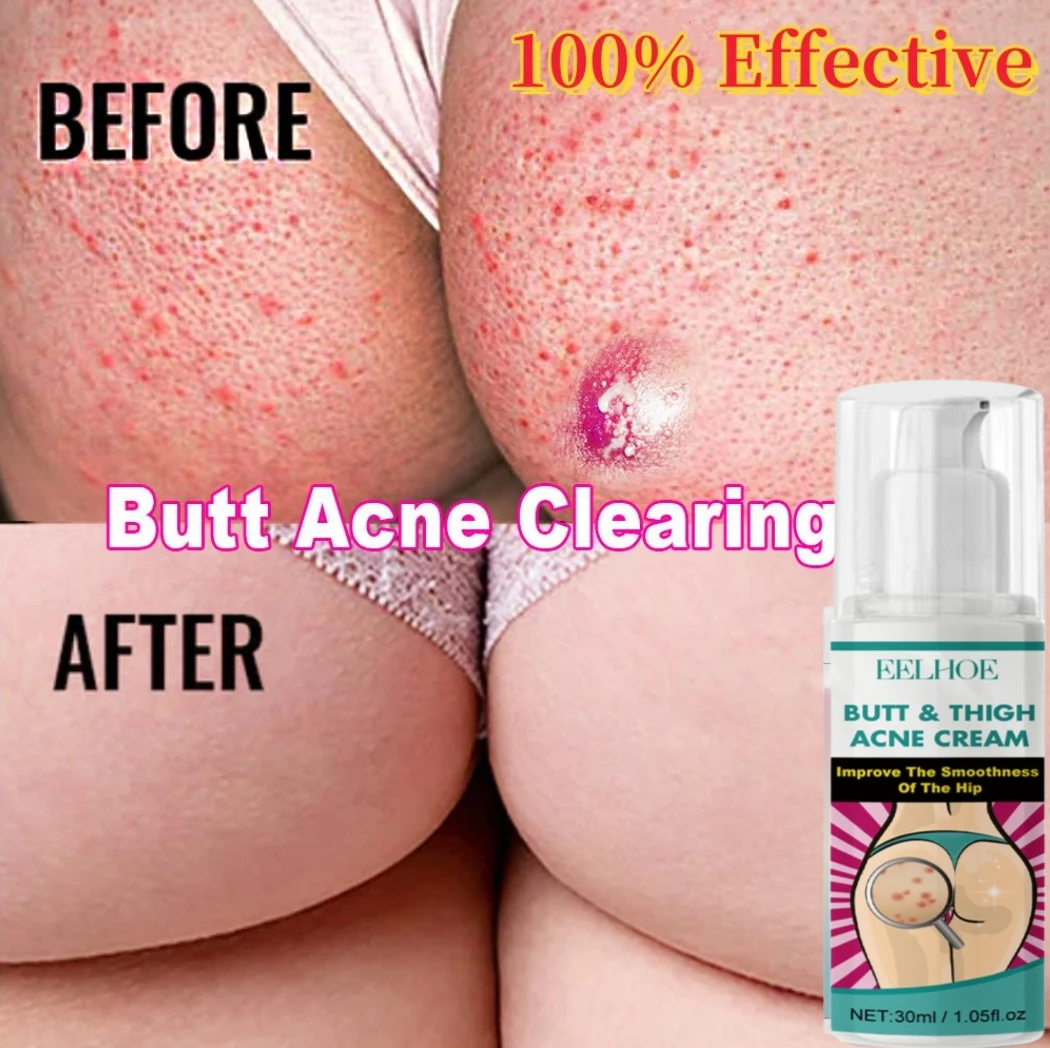 Effective Acne Treatment Cream Remove Acne Mark On Buttock Thigh Back Clear Face Dark Spot Pimples Zit Pore Clogging Body Lotion