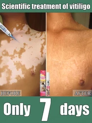 Trate o vitiligo. Remova manchas brancas rapidamente