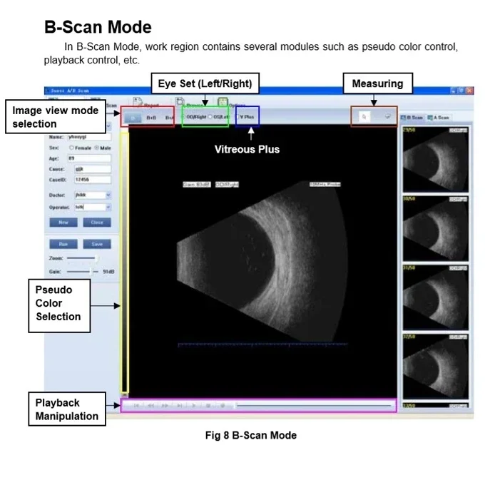 أداة طب العيون المحمولة من Holyavision، اختبار العين بالموجات فوق الصوتية، مسح AB #4