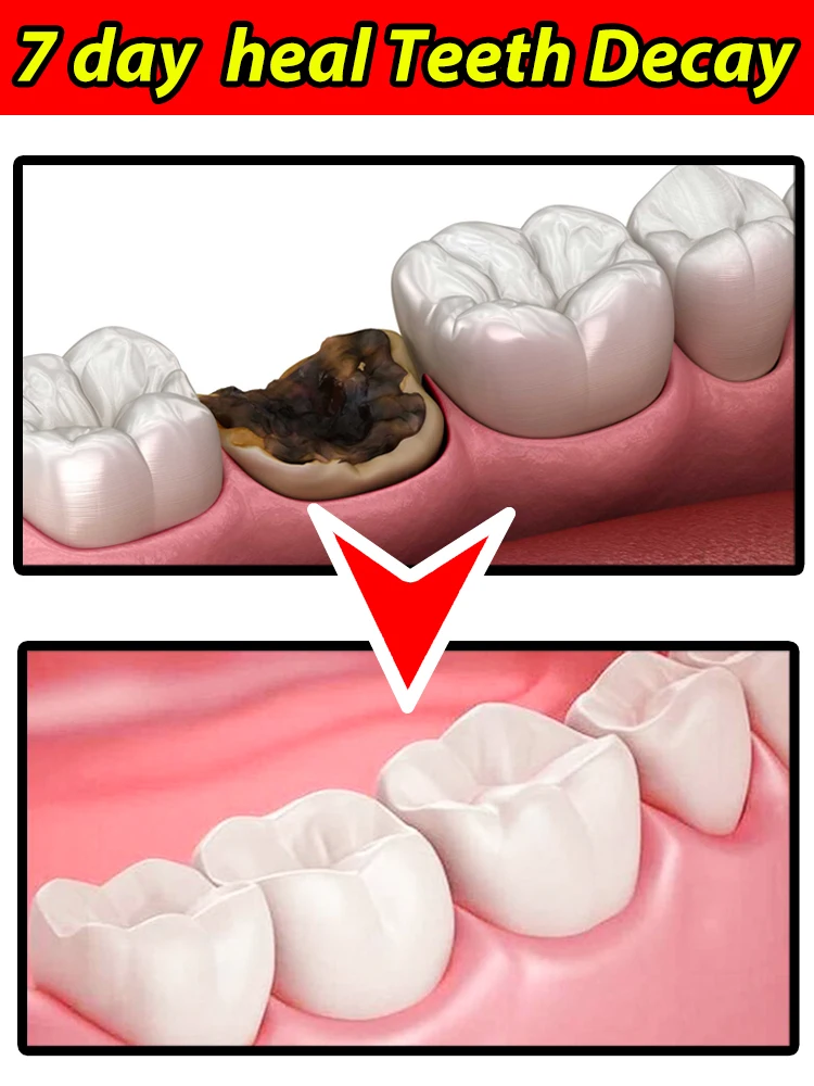 Réparation de la carie dentaire, traitement des caries, anti-cavités