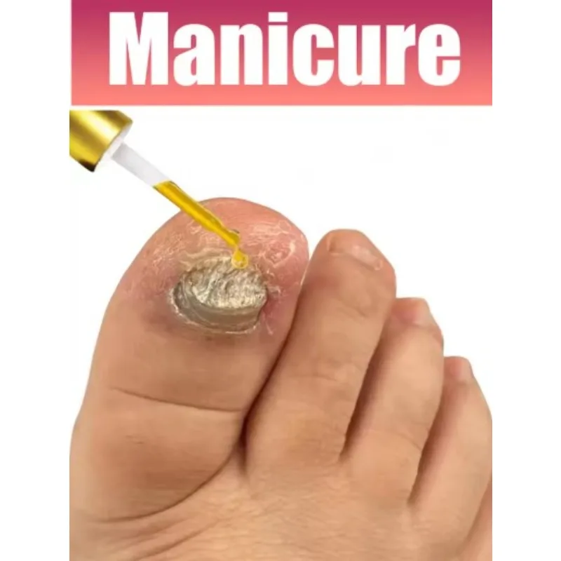 

2025 Toenail Fungus Patch Waterproof Nail Repair Patches Nail Ingrown Correction Sticker Discolored Damaged Nail Foot Care Tool