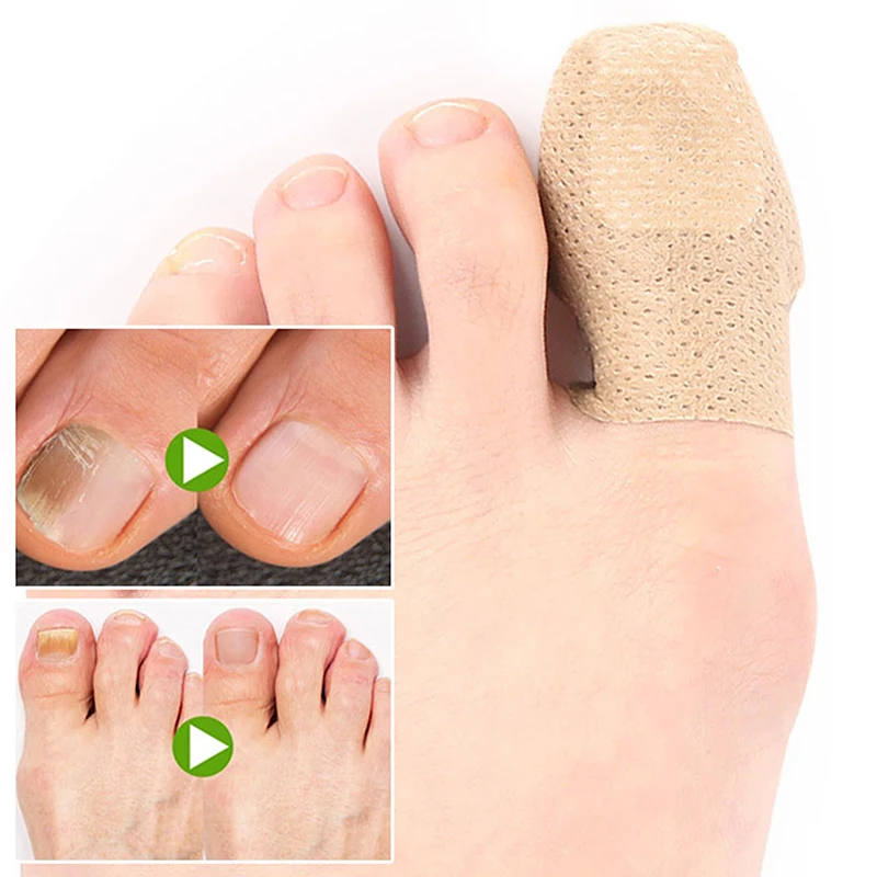 10Pcs Zehennagel Pilz Patch Nagel Reparatur Patches Nagel Eingewachsene Korrektur Aufkleber Für Verfärbte Oder Beschädigte Nägel Pflege