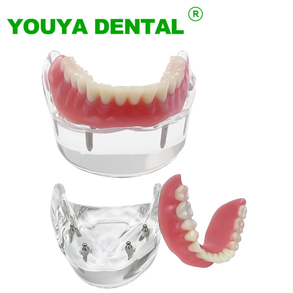 Dental Teeth Model With 4 Implants Overdenture Restoration Superior Demo Model For Dentist Patient Treatment Communication Model