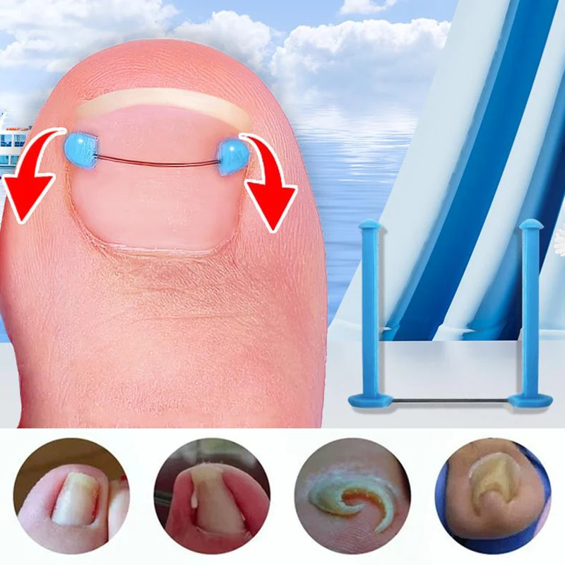 12-22mm Ingrown Toenail Correction Wire Professional Treatment Embed Toe Nail Pedicure Straightening Toe Tools