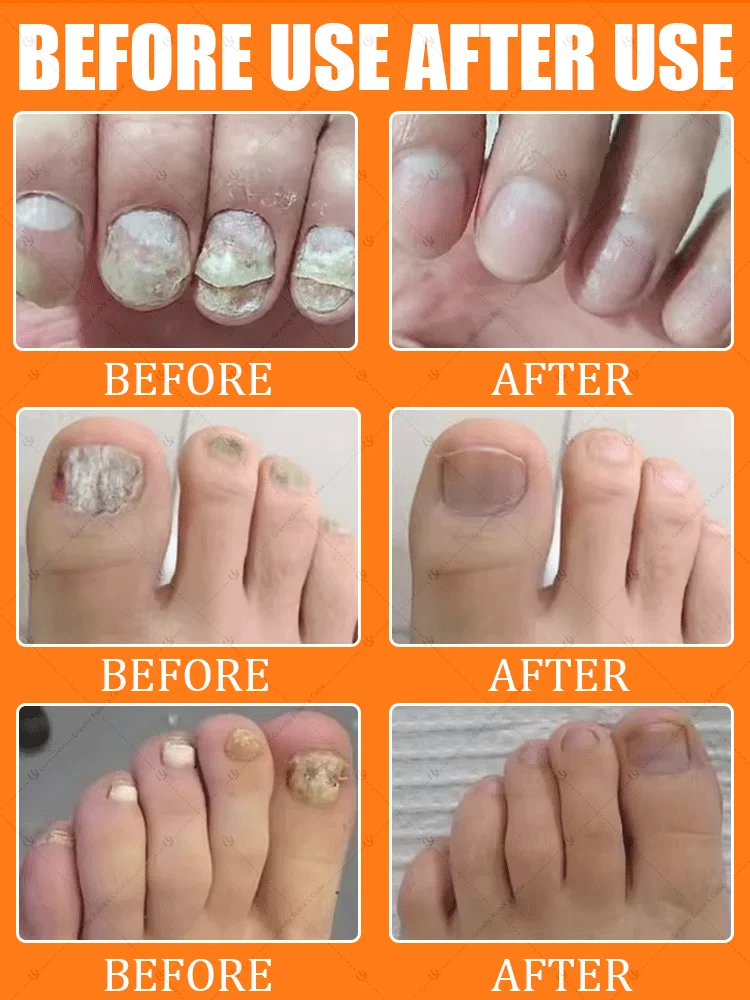 Nagelbürste Blaulicht-Laserwerkzeuge der zweiten Generation