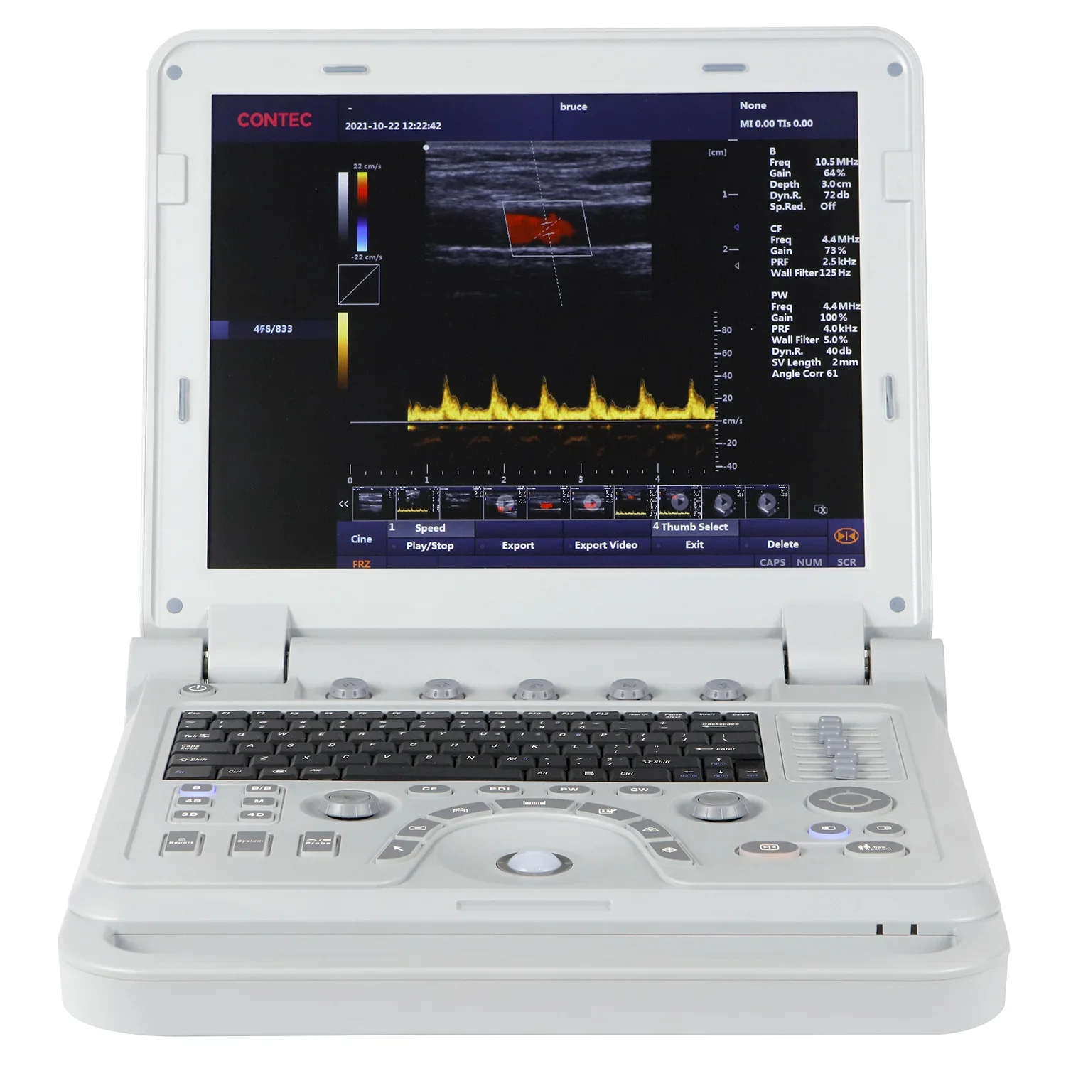 CONTEC CMS1700A colour doppler  ultrasound scanner portable echocardiography machine