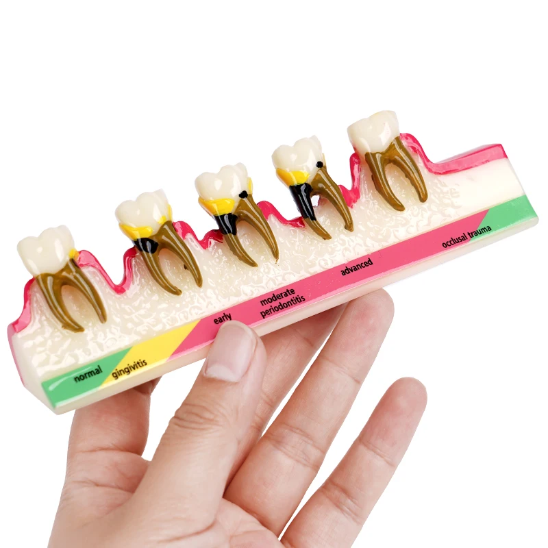 1pc Periodontal Disease Model 5-Stage Perio Disease Assort Demo Caries Periodontitis Dental Teeth Model For Dentistry Teaching