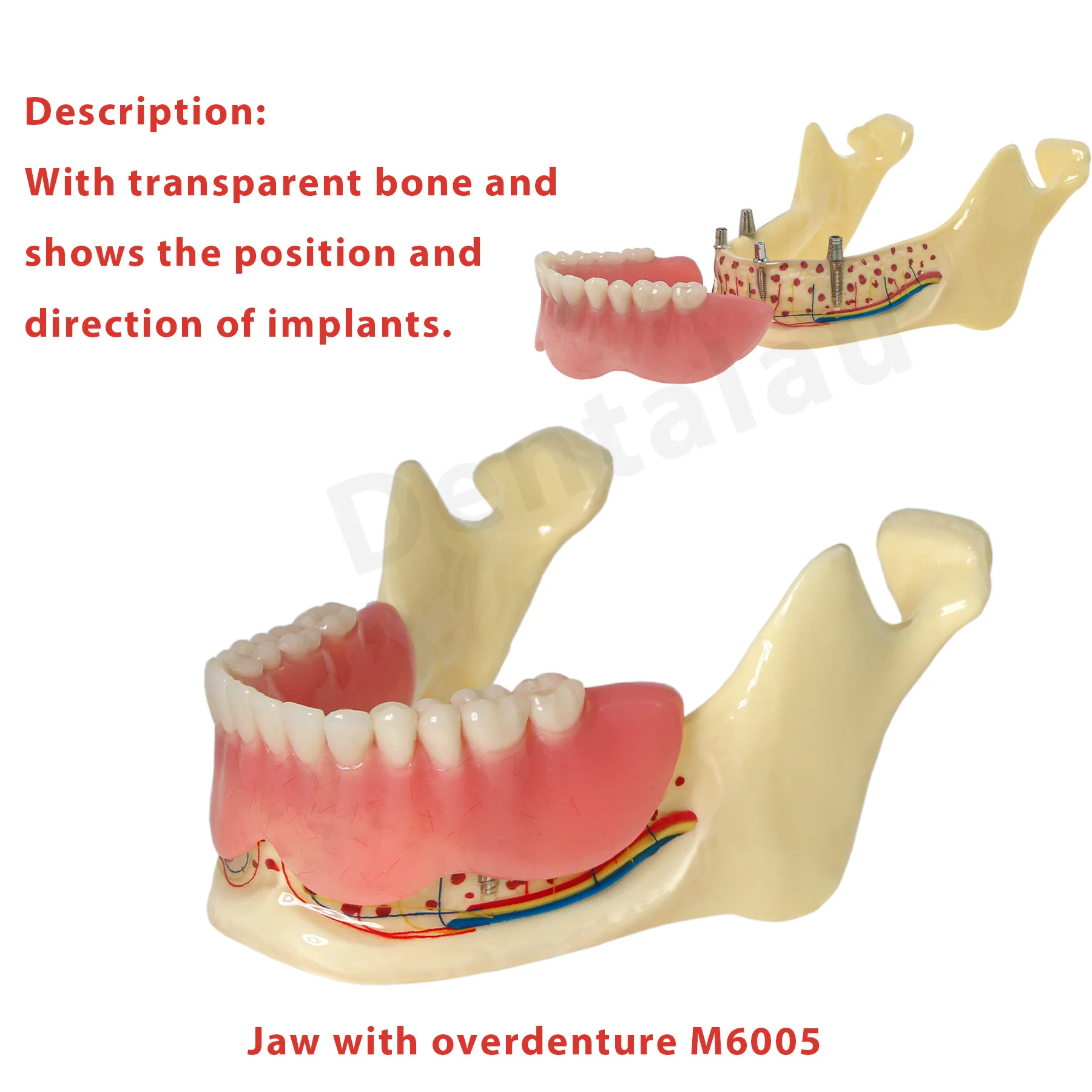 

Dental Overdenture Jaw Typodont Model Transparent Bone Implant Positions M6005