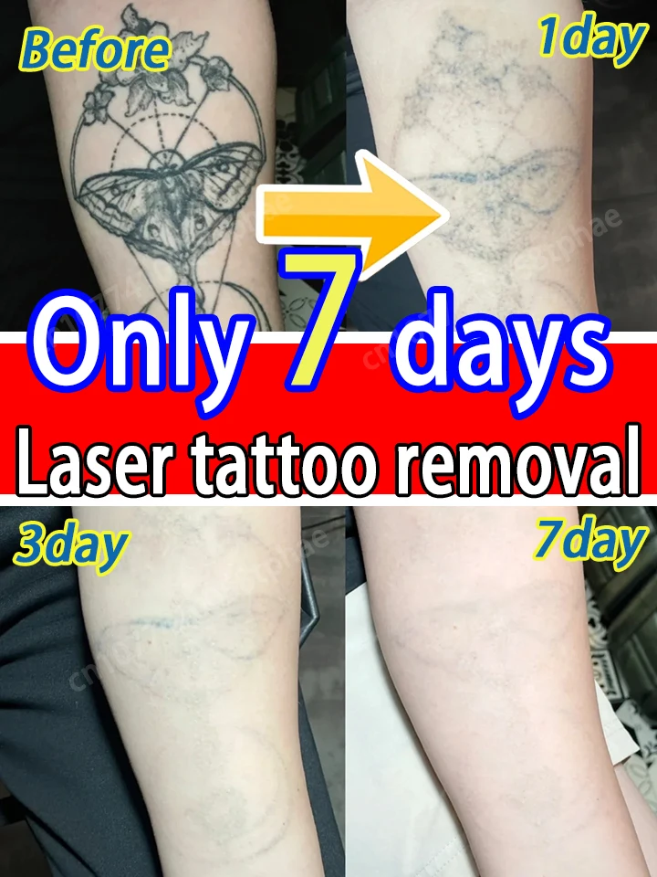 

laser pen,Wʀɪɴᴋʟᴇ-ғʀᴇᴇ ᴀɴᴅ ᴘᴀɪɴʟᴇss, sᴋɪɴ ʀᴇɢᴇɴᴇʀᴀᴛɪᴏɴ,Tʜᴇ Cʟᴇᴀɴᴇsᴛ Pʀᴏᴅᴜᴄᴛs！！
