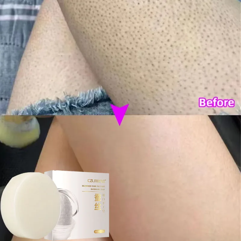 

Chicken Skin Removal Body Whitening Soap Keratosis Pilaris Skin Repair Soap Smooth Moisturize Body Brighten White Care Products