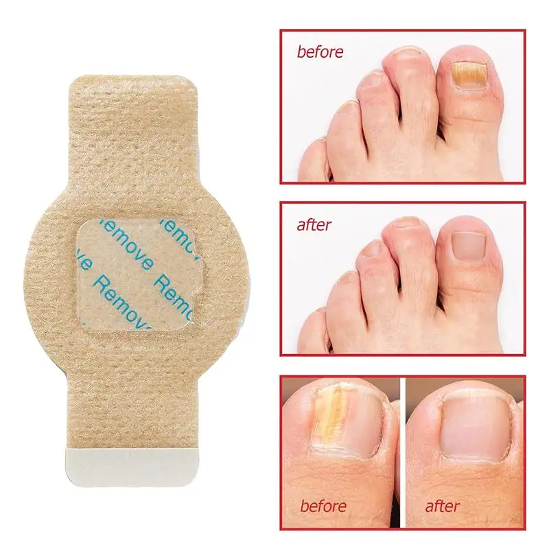 B*New 21/63/105Pcs Nail Repair Patches Toenail Fungus Patches Nail Ingrown Correction Stickers For Discolored Or Damaged Nails