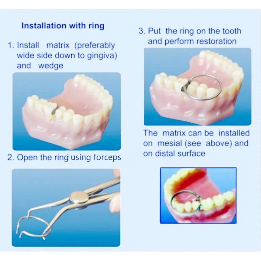 100Pcs Dental Sectional Contoured Matrices Matrix Bands 35μm with 2 Rings No.1.398 Matrix Band Forming Clip