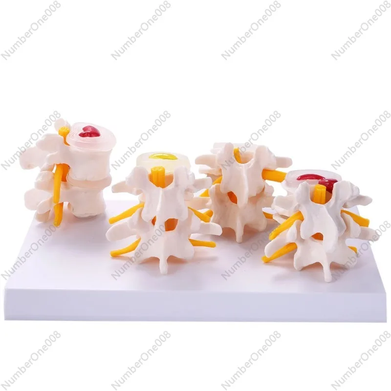 

Human Anatomy Skeleton Spine 4-Stages Lumbar Vertebral Model Brain Skull Traumatic Teaching Supplies