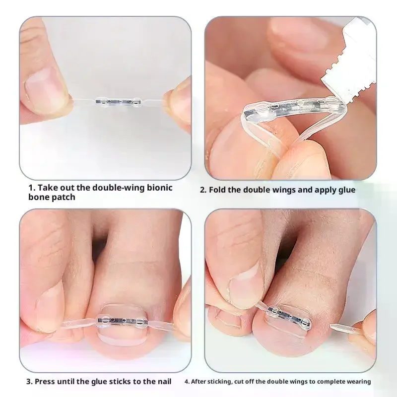 Werkzeuge zur Korrektur eingewachsener Zehennägel, Pediküre, Wiederherstellung, Einbettung der Zehennägel, professionelle Clip-Klammer zur Glättung eingewachsener Zehennägel