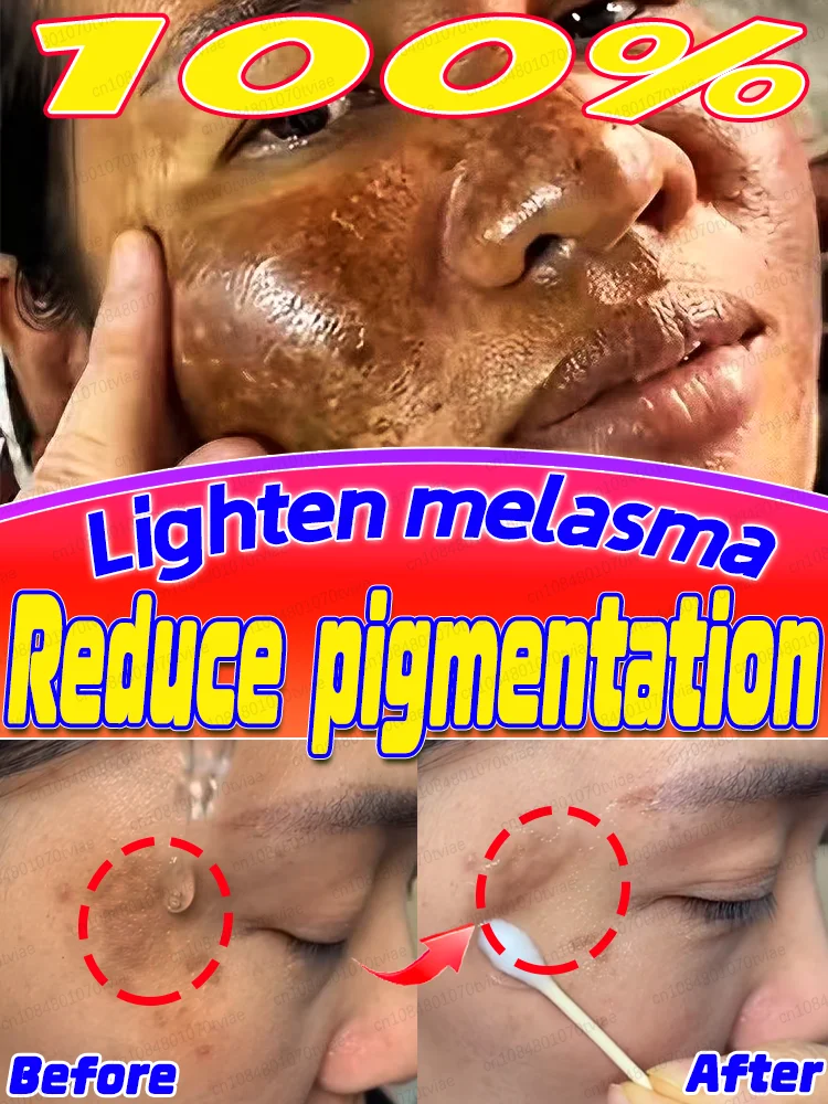

Lɪɢʜᴛᴇɴ ғʀᴇᴄᴋʟᴇs Reduce pigmentation and lighten freckles Effectively combat freckles and pigmentation problems