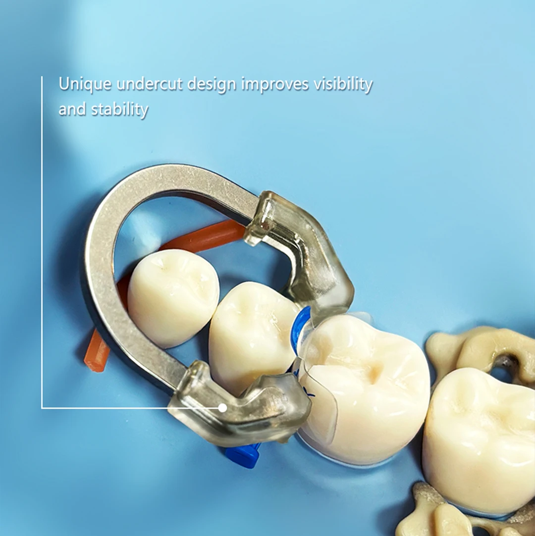 

1 шт., стоматологическое зажимное кольцо NiTi с прозрачной головкой | Мощное разделение | Безопасная и складная стоматологическая матричная система