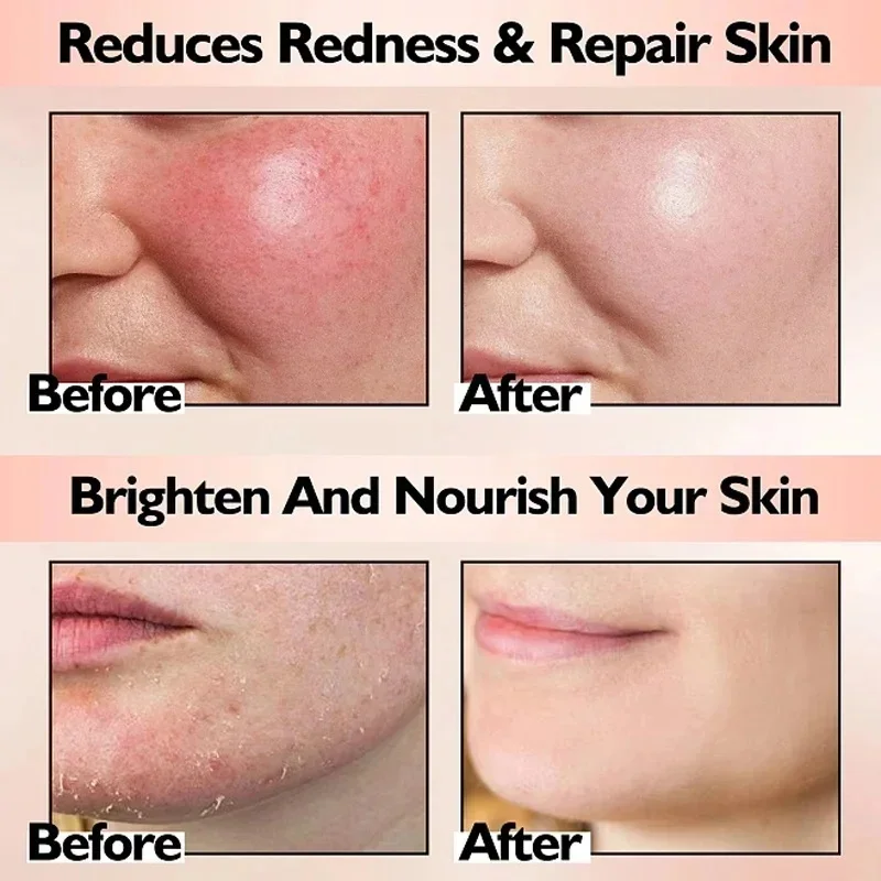 ครีมซ่อมแซมรอยแดงบนใบหน้าปรับปรุงผิวบอบบางความแห้งกร้าน Moisturizer Hydrating Sooth Lotion Removal Rosacea เครื่องสําอางเกาหลี