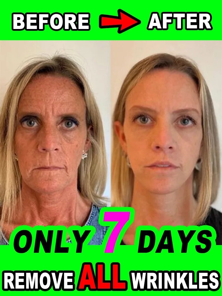 

wrinkles disappeared