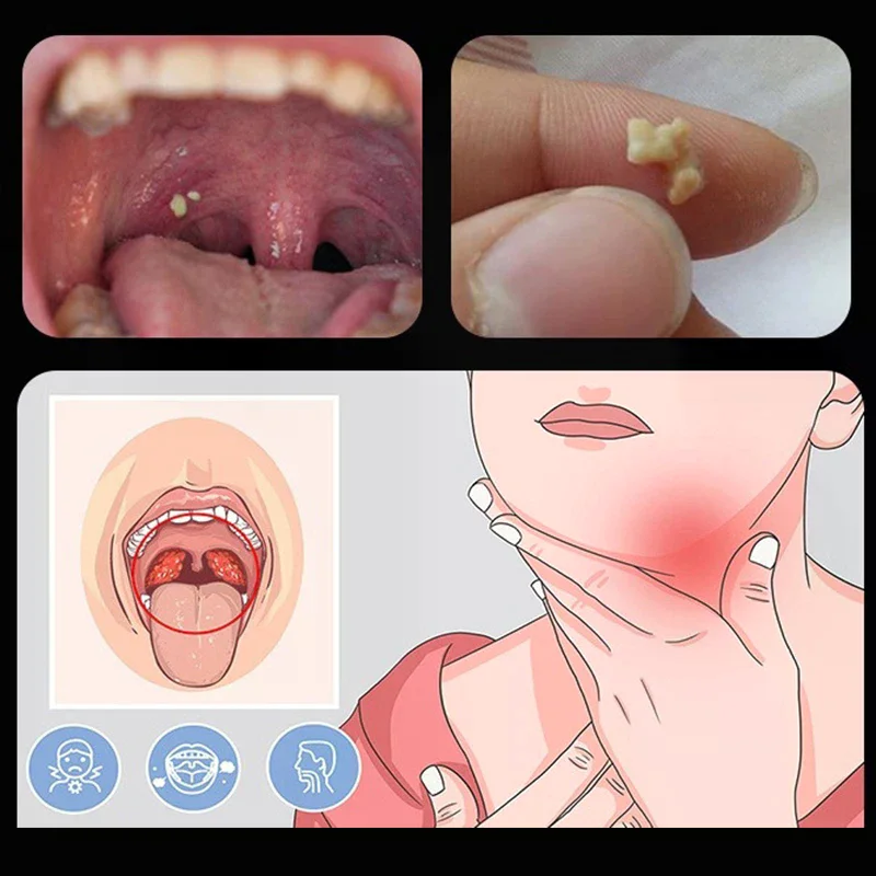 Wax Tonsil Stone Remover Tool LED Light Stainless Steel Remover Mouth Cleaning Care Tools Ear